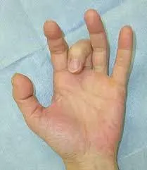ばね指　腰痛　５１歳　女性　主婦
