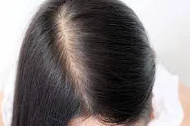 脱毛症の種類と原因と治療