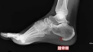 足の裏の痛み　手首の腱鞘炎　６０歳　女性　主婦