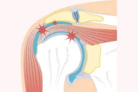 肩関節周囲炎に鍼治灸治療でのツボ刺激が効果的
