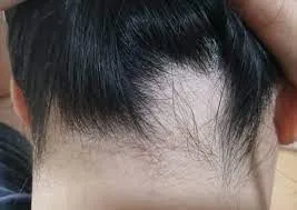 円形脱毛症　肩こり　目の下のくま　４２歳　女性　会社員