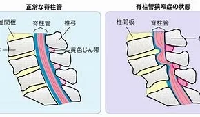 脊柱管狭窄症には鍼灸が効果的