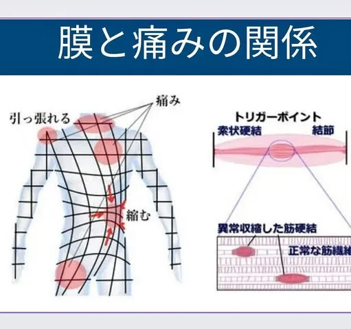 筋膜リリースのファシアスリックテクニックの有効性