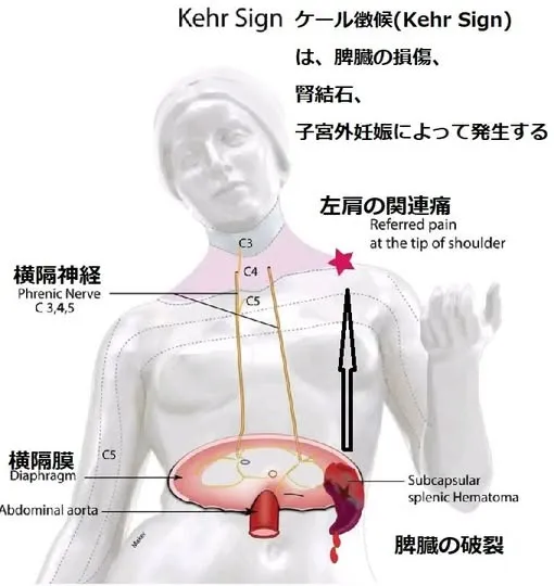 【科学の最前線：横隔膜の内臓体性反射「関連痛」は首と肩の症状となる】