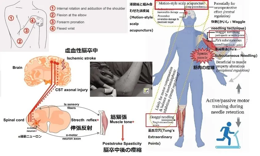 【鍼灸EBM最前線：鍼のエビデンスの現状「鍼がポジティブな効果を出す可能性が高い疾患」(19)「脳卒中後の痙縮」】
