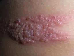 帯状疱疹に対するツボ療法