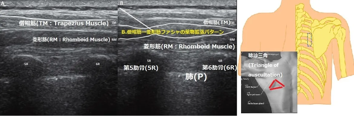 【肩こりの最前線：僧帽筋・菱形筋ファシア】
