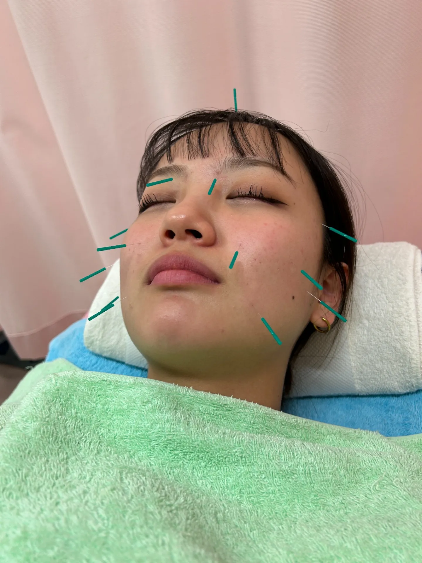 美容はり – あなたの「真の美しさ」を呼び覚ます